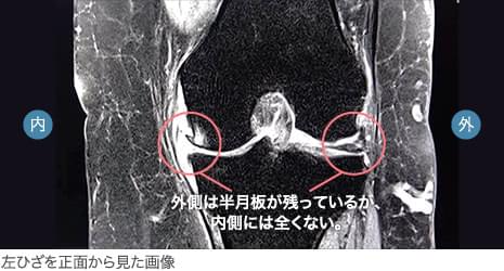 60代前半・女性／変形性膝関節症（末期）