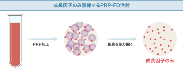 成長因子のみ濃縮するPRP-FD注射