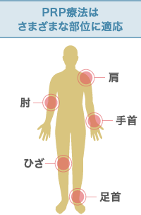 PRP療法はさまざまな部位に適応