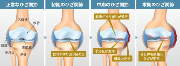 注射 膝 酸 ヒアルロン