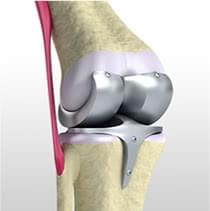 変形性ひざ関節症の手術的治療