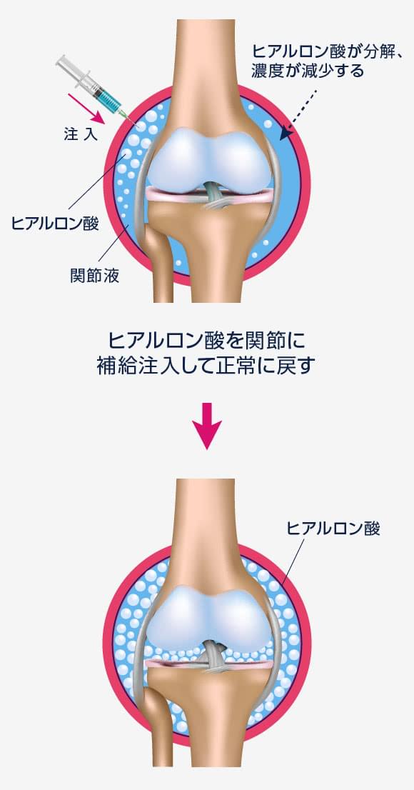 ヒアルロン酸注射について｜大宮ひざ関節症クリニック